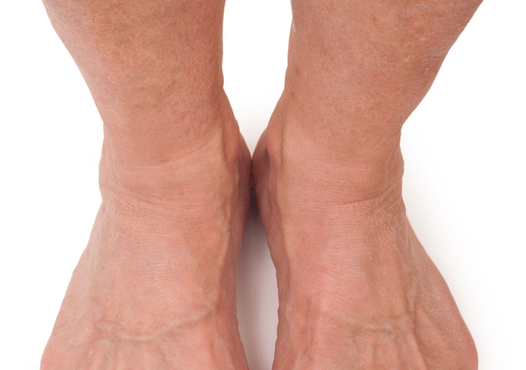 arthrose-sprunggelenk-1